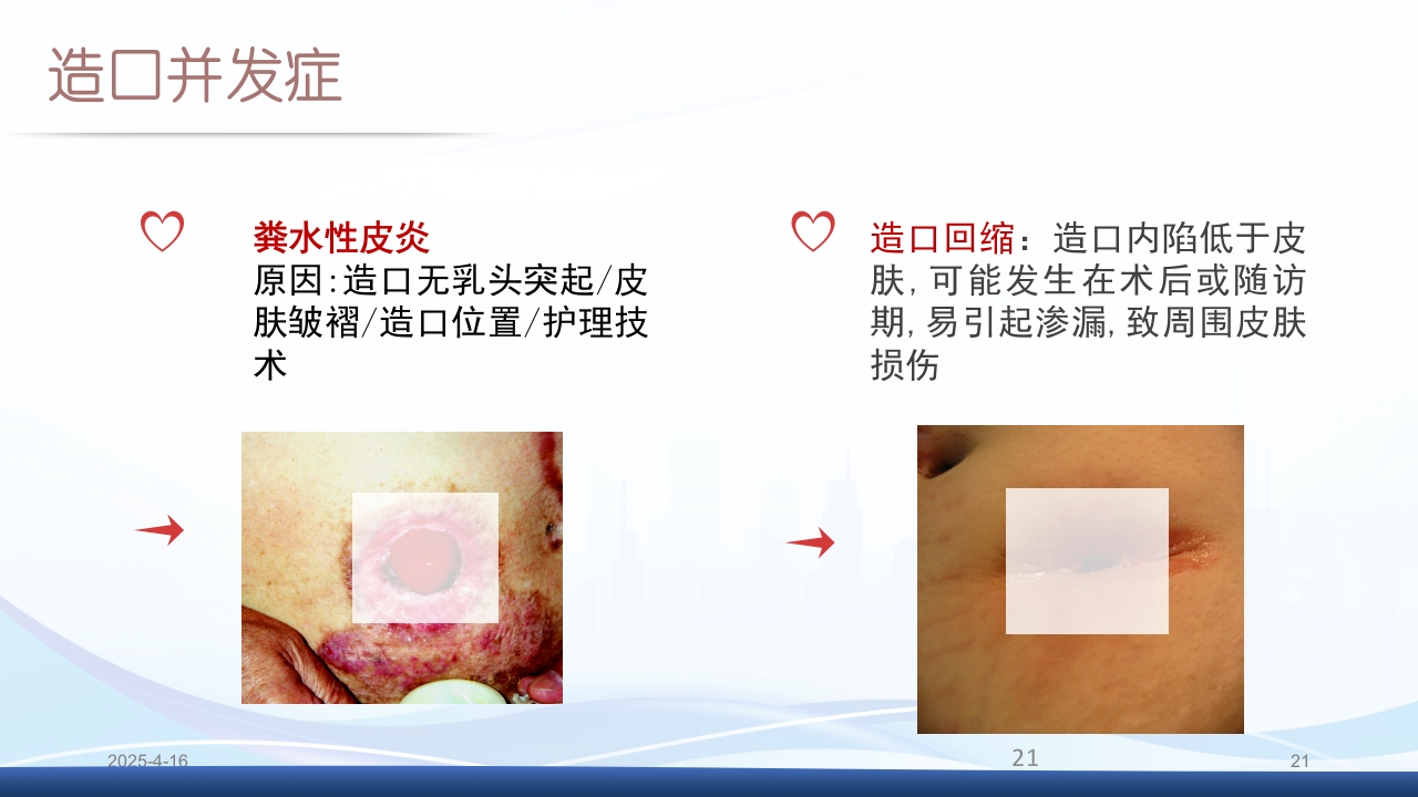 膀胱全切+回肠膀胱造口围手术期的护理查房PPT课件21