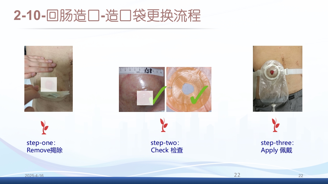 膀胱全切+回肠膀胱造口围手术期的护理查房PPT课件22