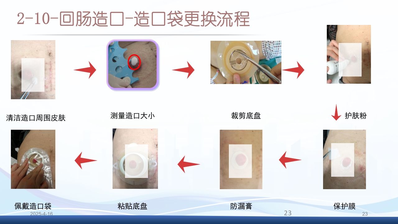 膀胱全切+回肠膀胱造口围手术期的护理查房PPT课件23