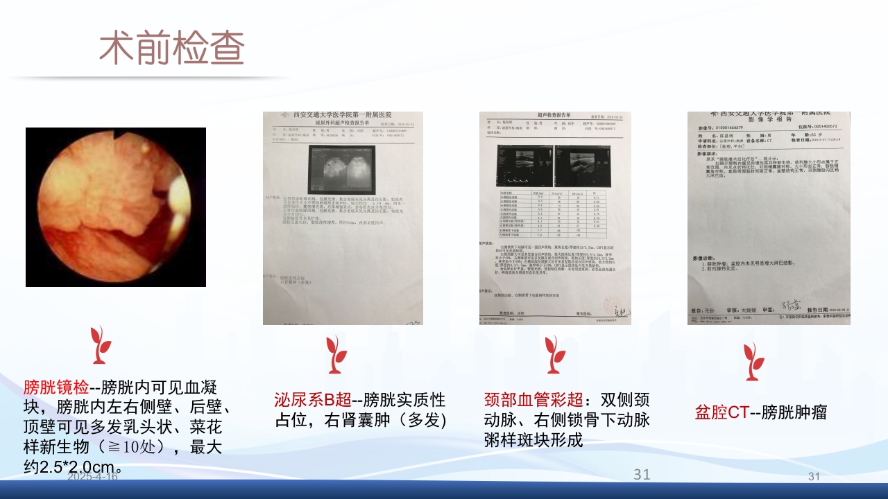 膀胱全切+回肠膀胱造口围手术期的护理查房PPT课件31
