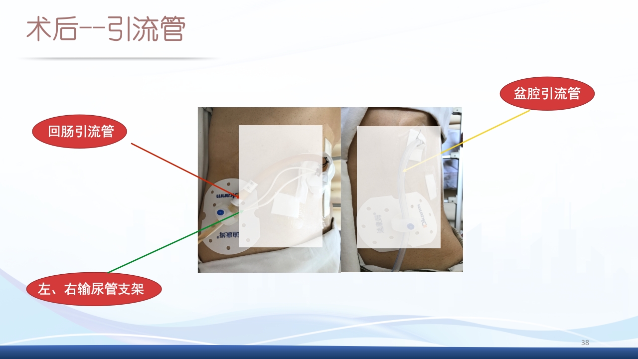 膀胱全切+回肠膀胱造口围手术期的护理查房PPT课件38