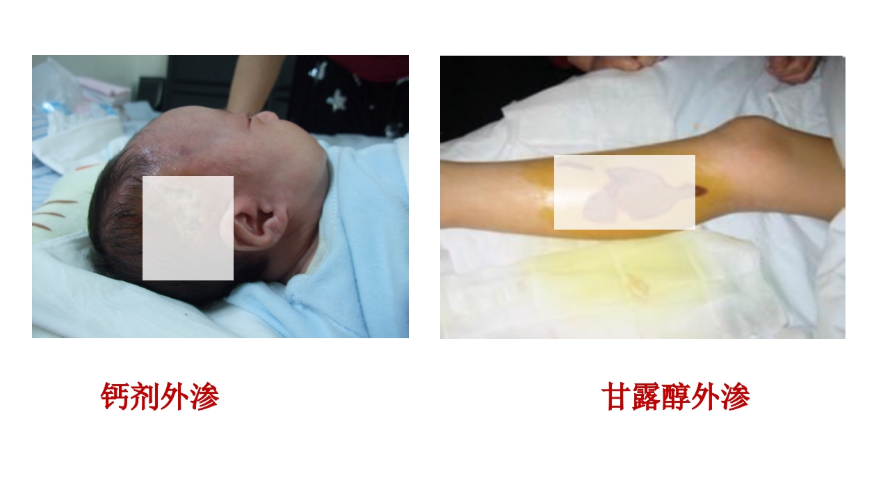 药物外渗和渗出的预防和处理PPT课件22