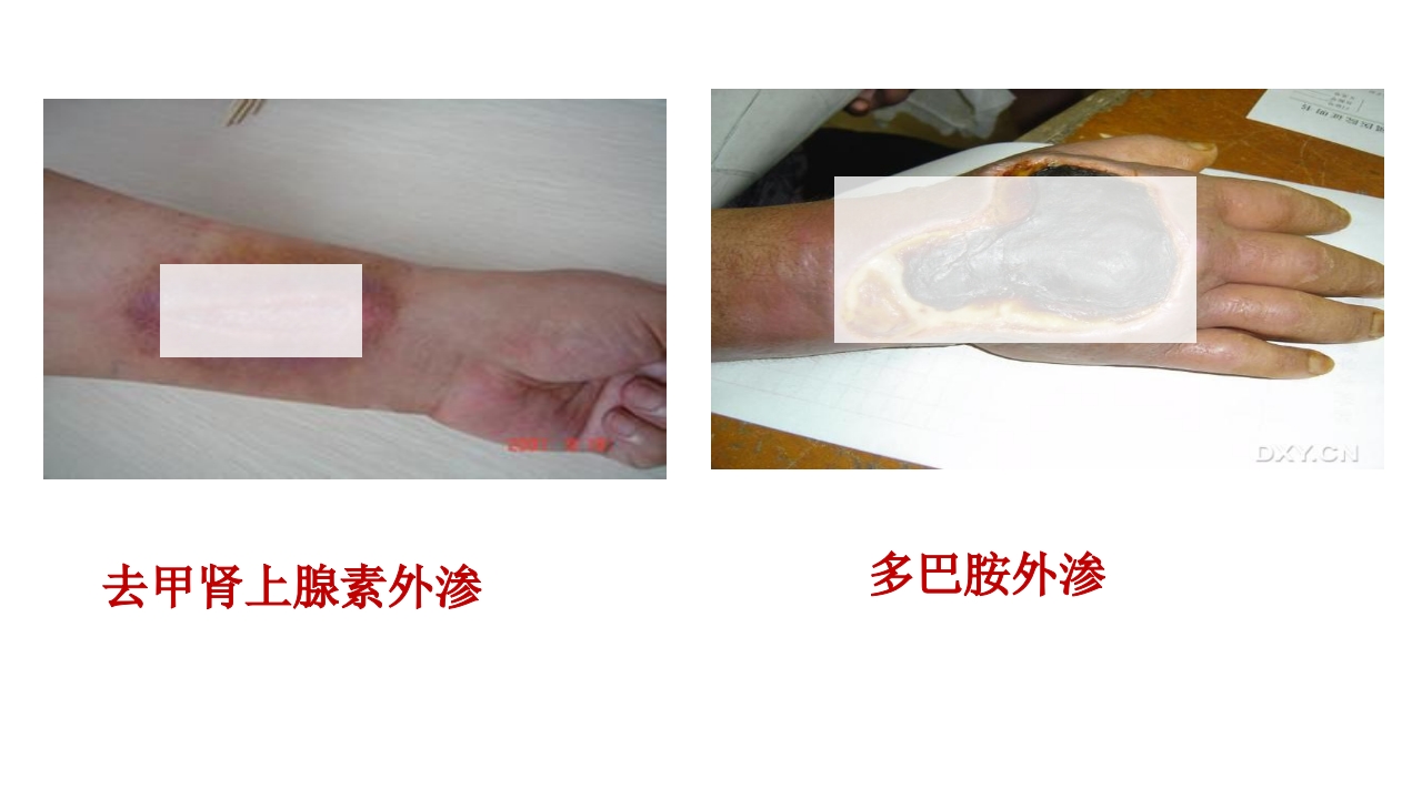 药物外渗和渗出的预防和处理PPT课件23