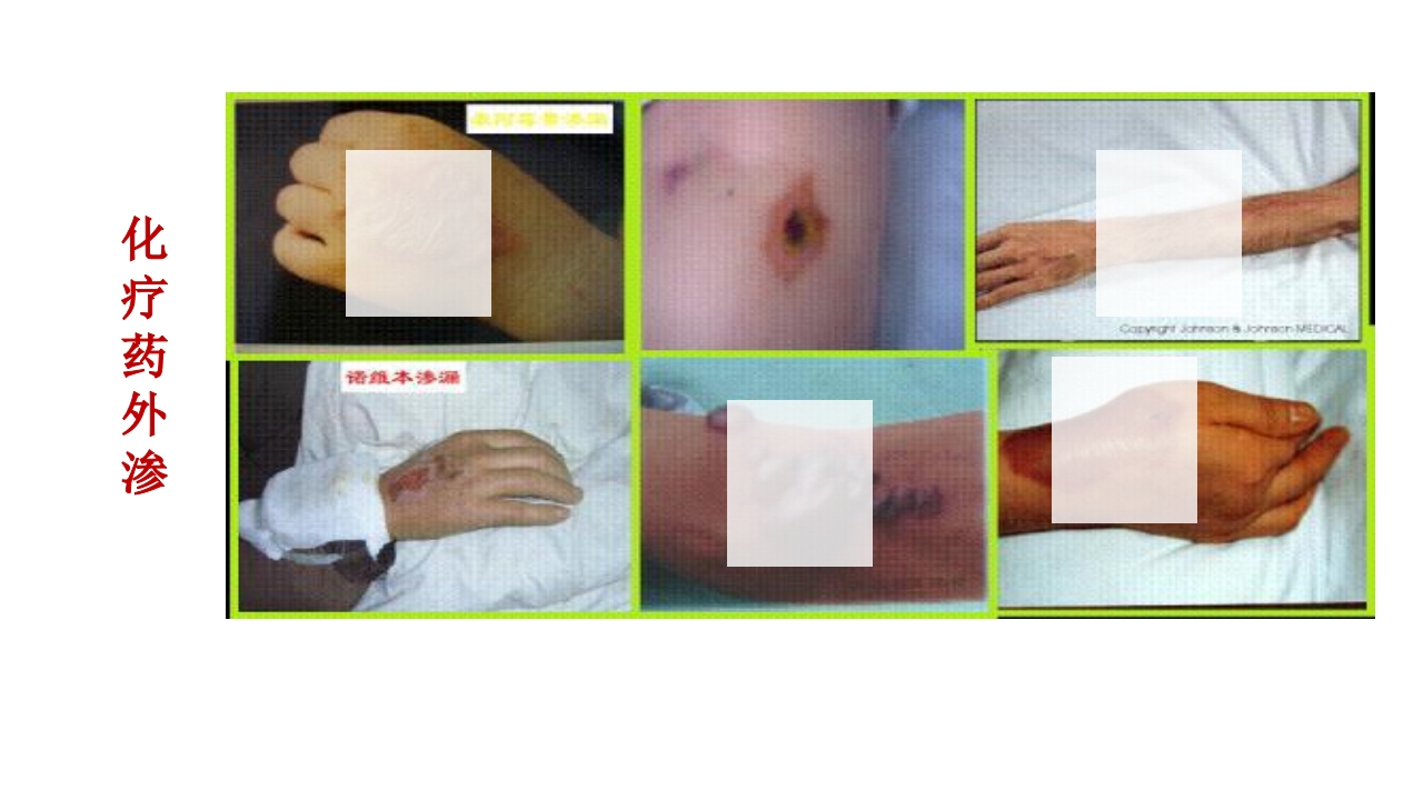 药物外渗和渗出的预防和处理PPT课件24