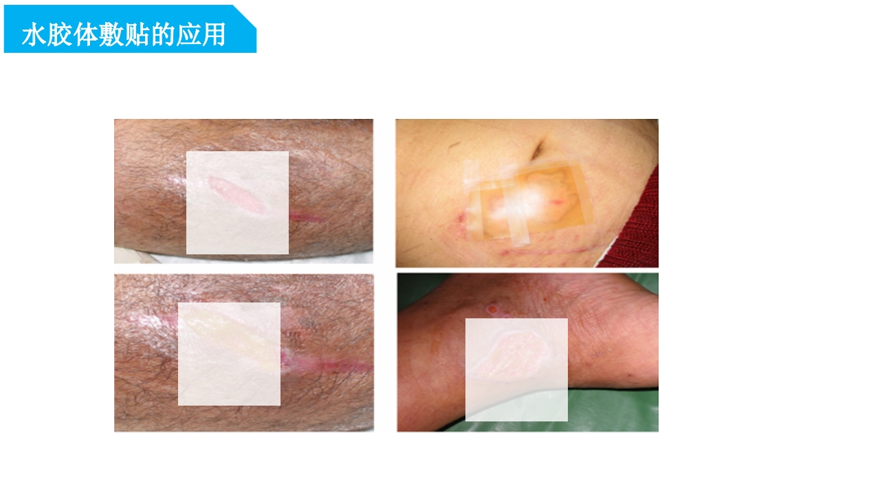 药物外渗和渗出的预防和处理PPT课件32