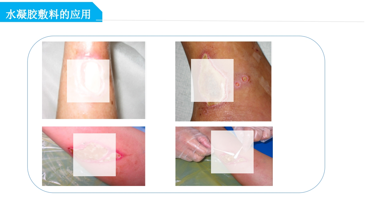 药物外渗和渗出的预防和处理PPT课件34