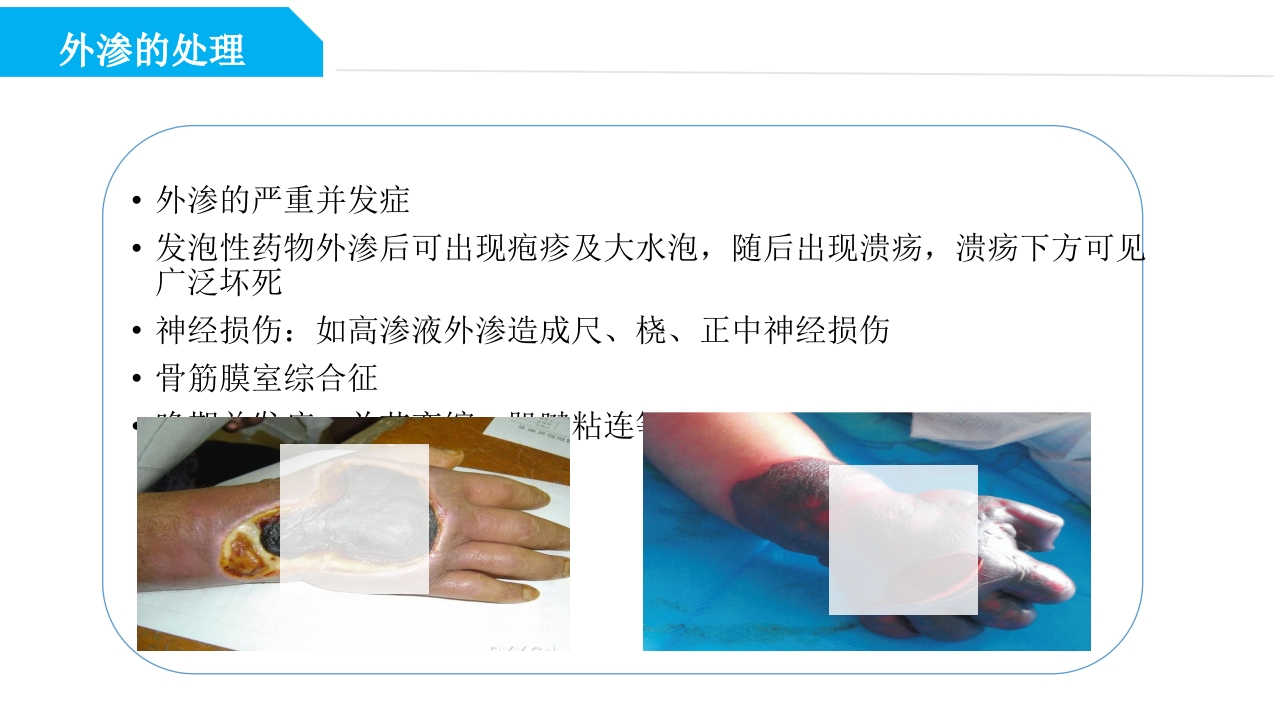药物外渗和渗出的预防和处理PPT课件40