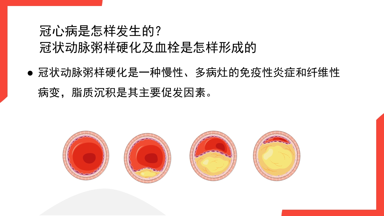老年心血管疾病介绍PPT课件12