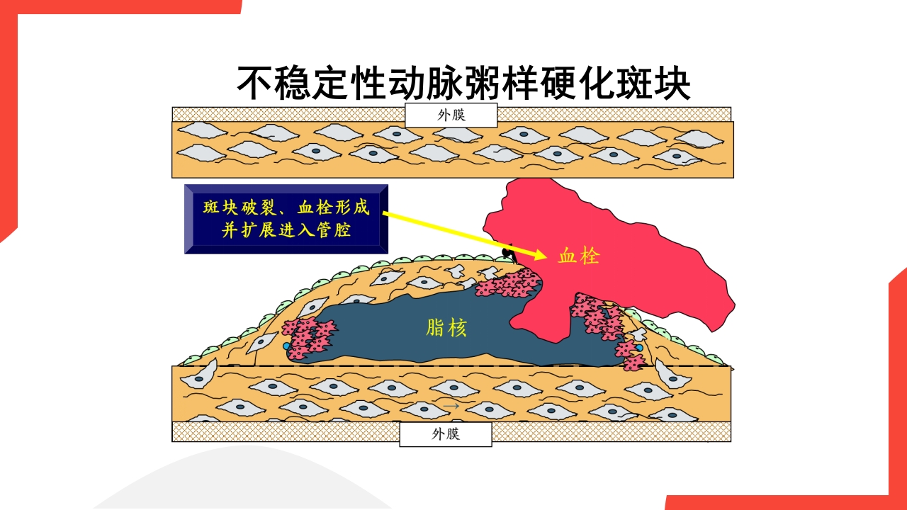 老年心血管疾病介绍PPT课件15