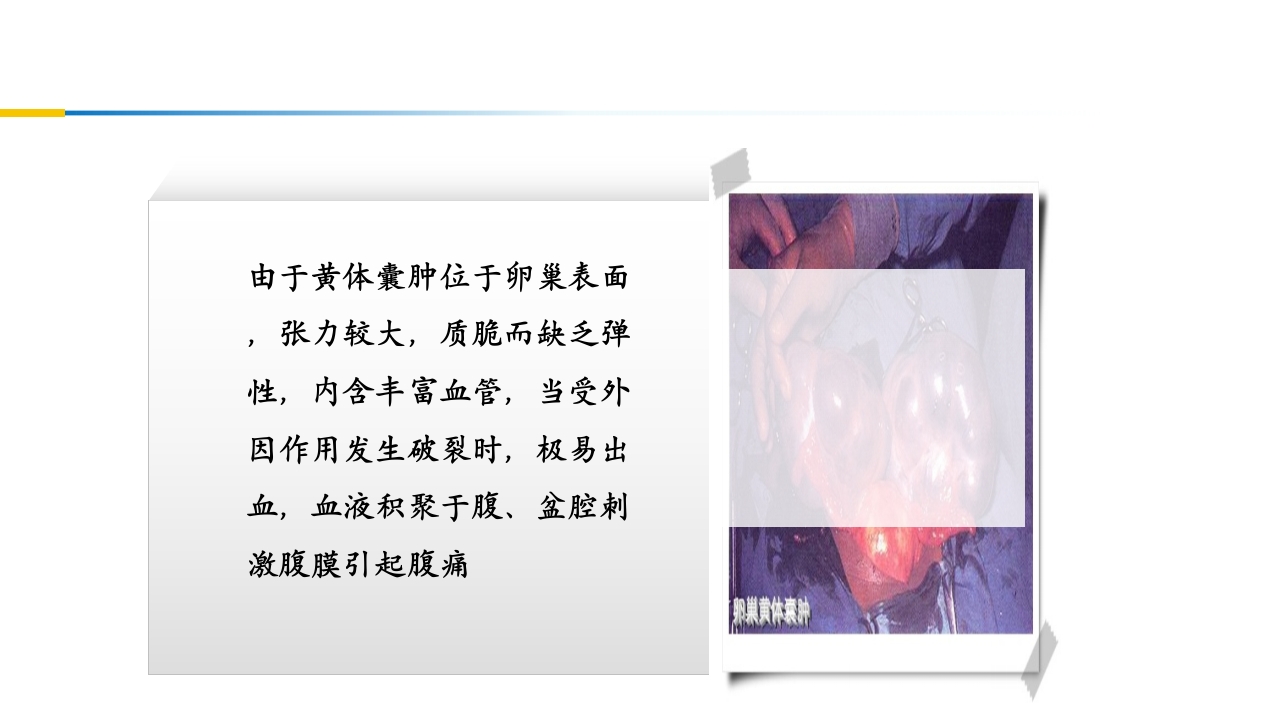 卵巢黄体破裂出血护理查房PPT课件11