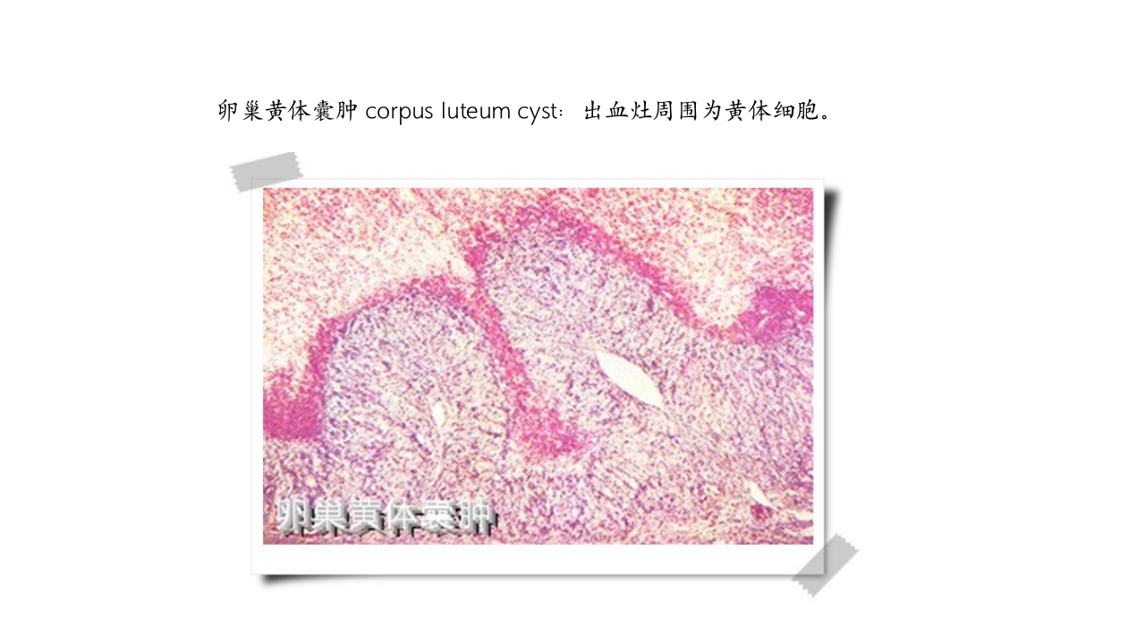 卵巢黄体破裂出血护理查房PPT课件17