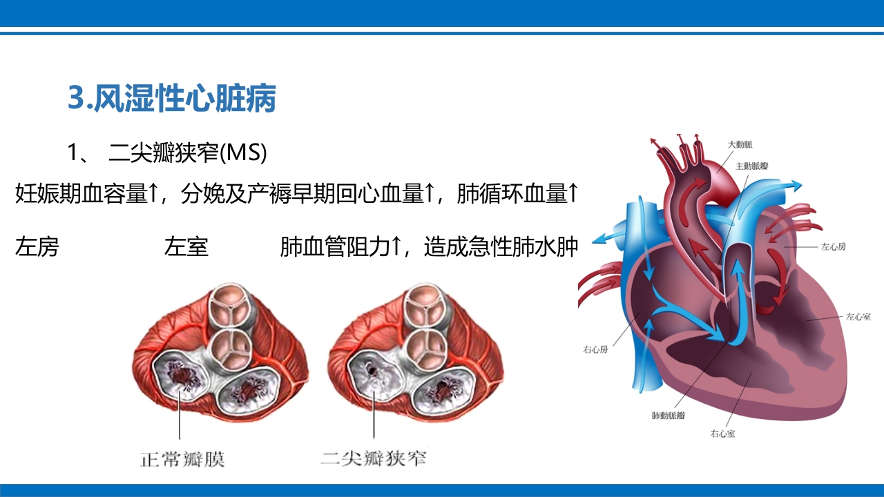 妊娠合并心脏病ppt课件6