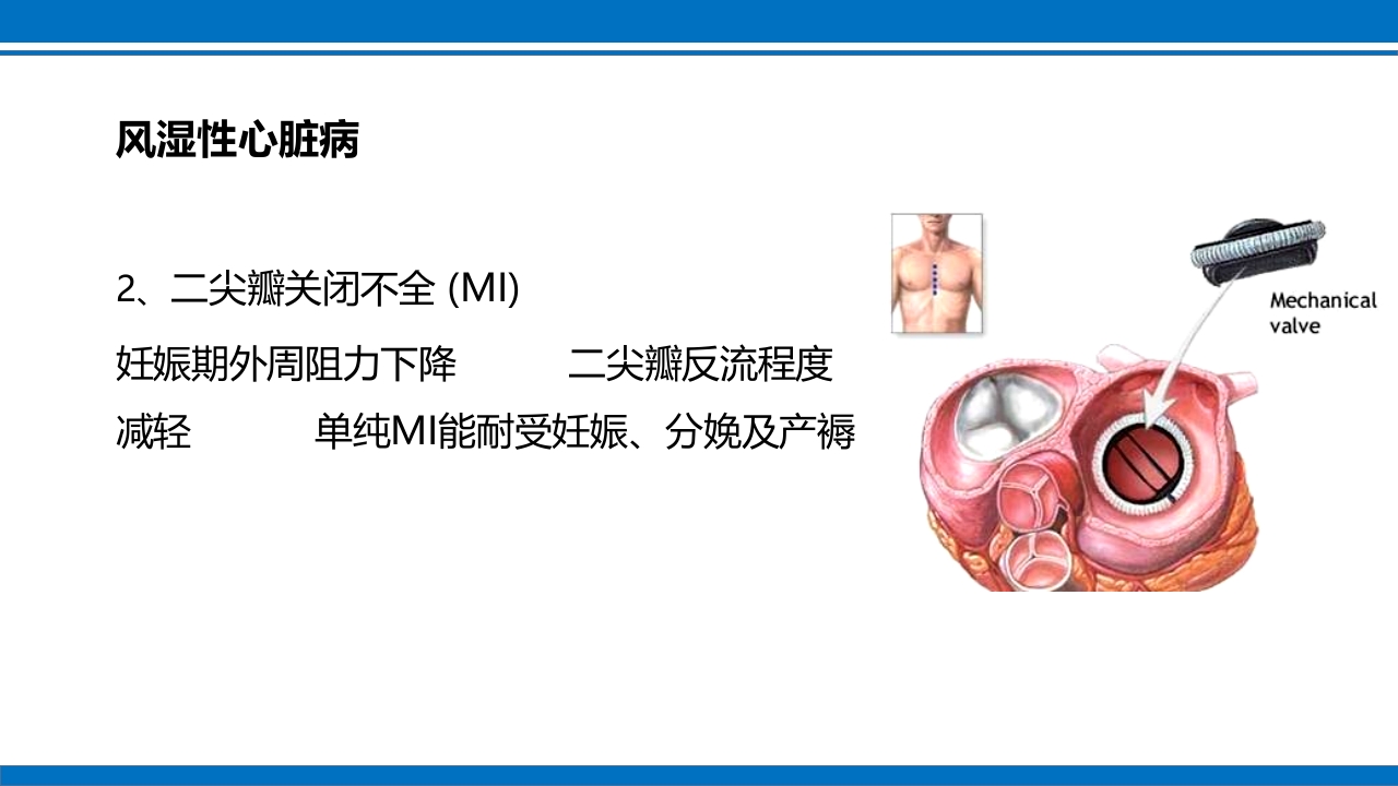 妊娠合并心脏病ppt课件7
