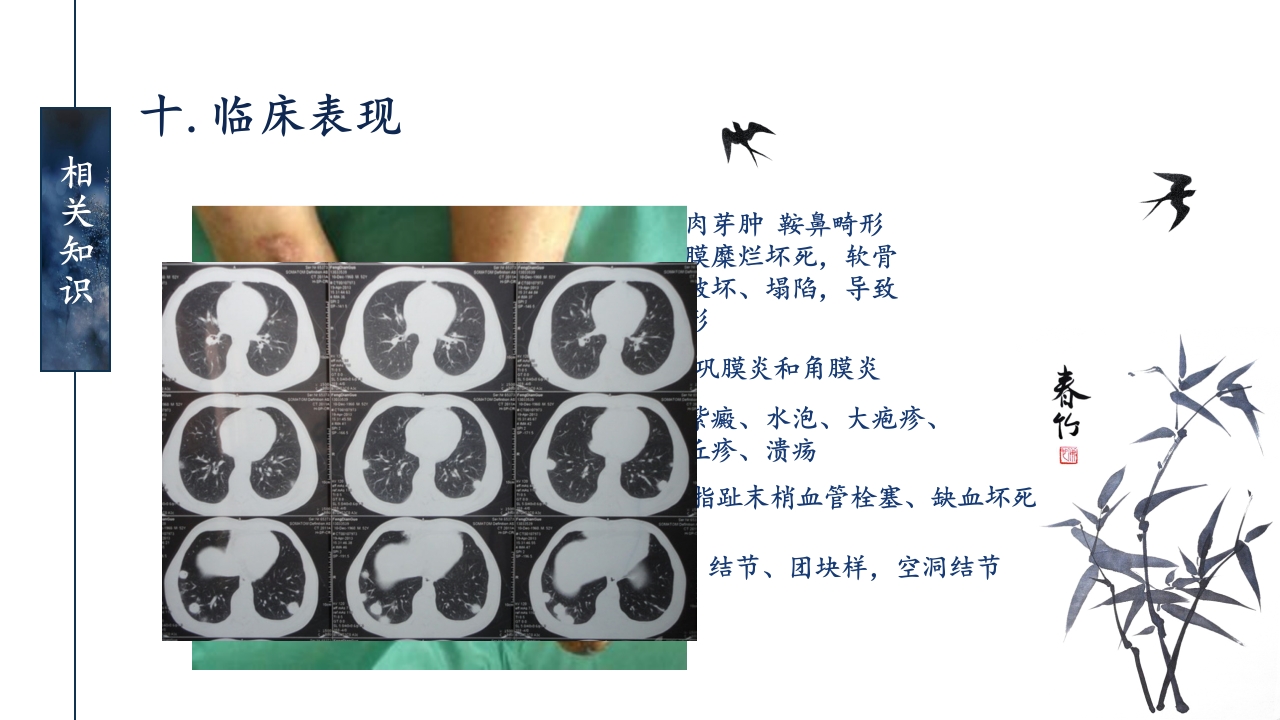 一例ANCA相关性血管炎患者的护理查房ppt课件21