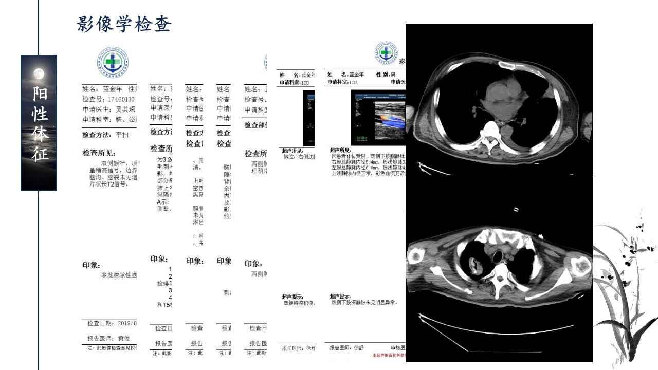 一例ANCA相关性血管炎患者的护理查房ppt课件48