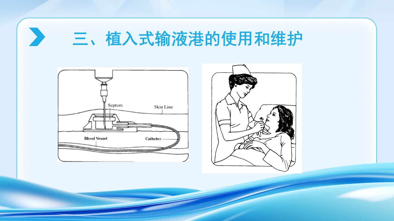 PICC CVC 输液港使用及维护ppt课件31