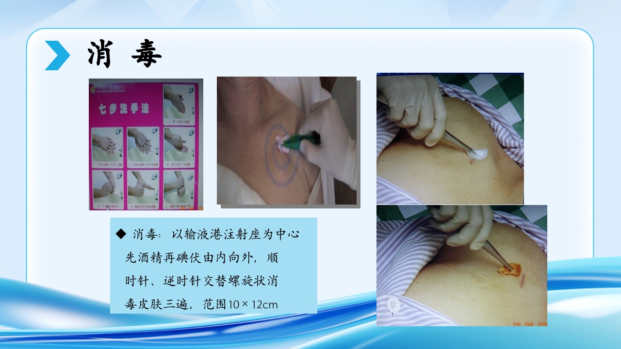 PICC CVC 输液港使用及维护ppt课件34