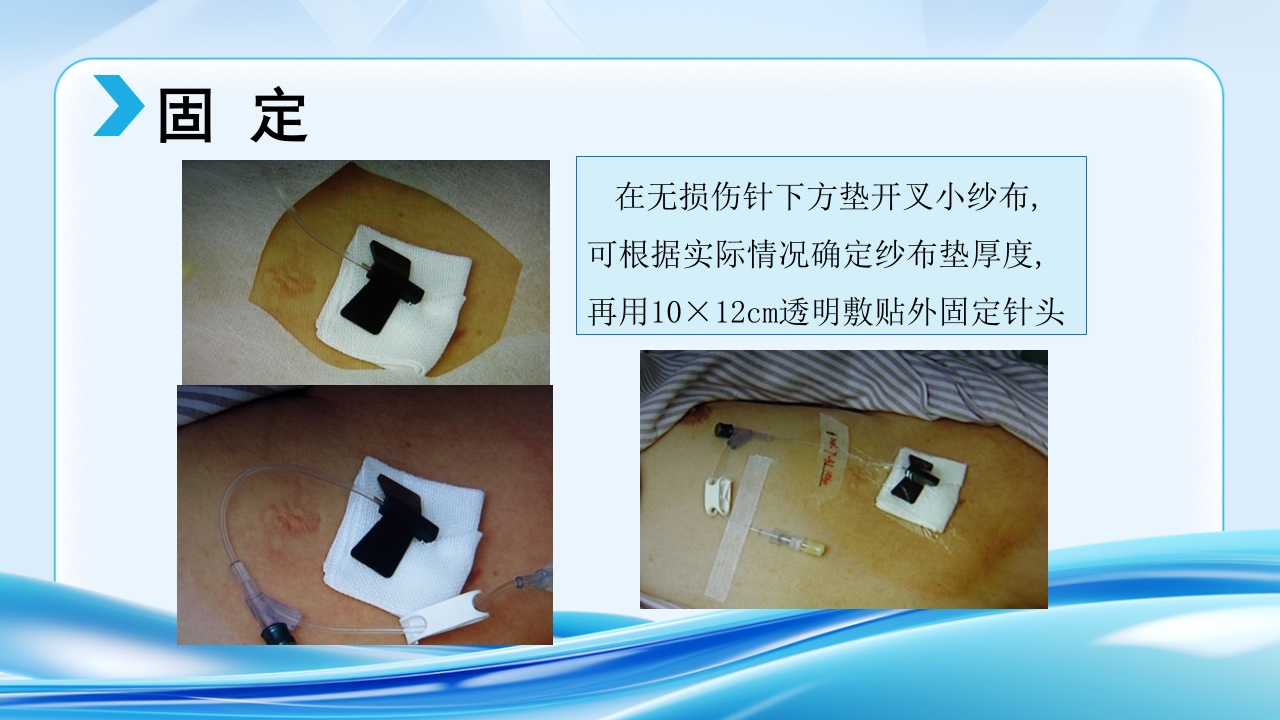 PICC CVC 输液港使用及维护ppt课件37