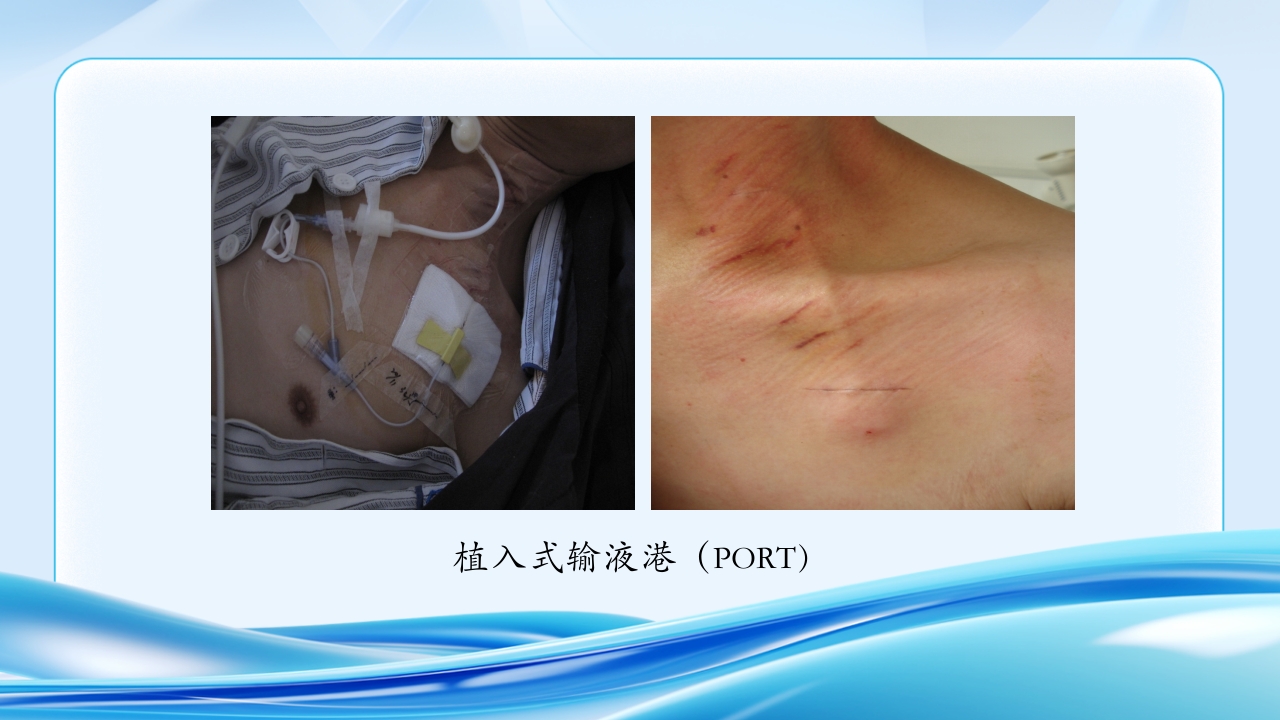 PICC CVC 输液港使用及维护ppt课件38