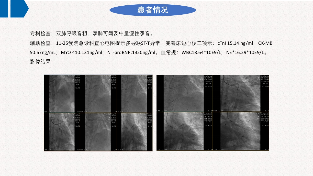 一例急性非ST段抬高型心肌梗死合并急性左心衰患者应用IABP辅助循环的护理查房PPT课件12
