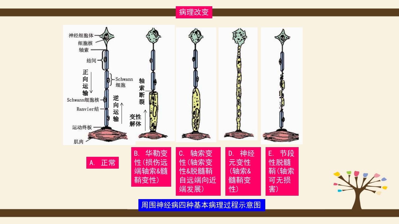 格林巴利综合症的护理查房PPT课件5