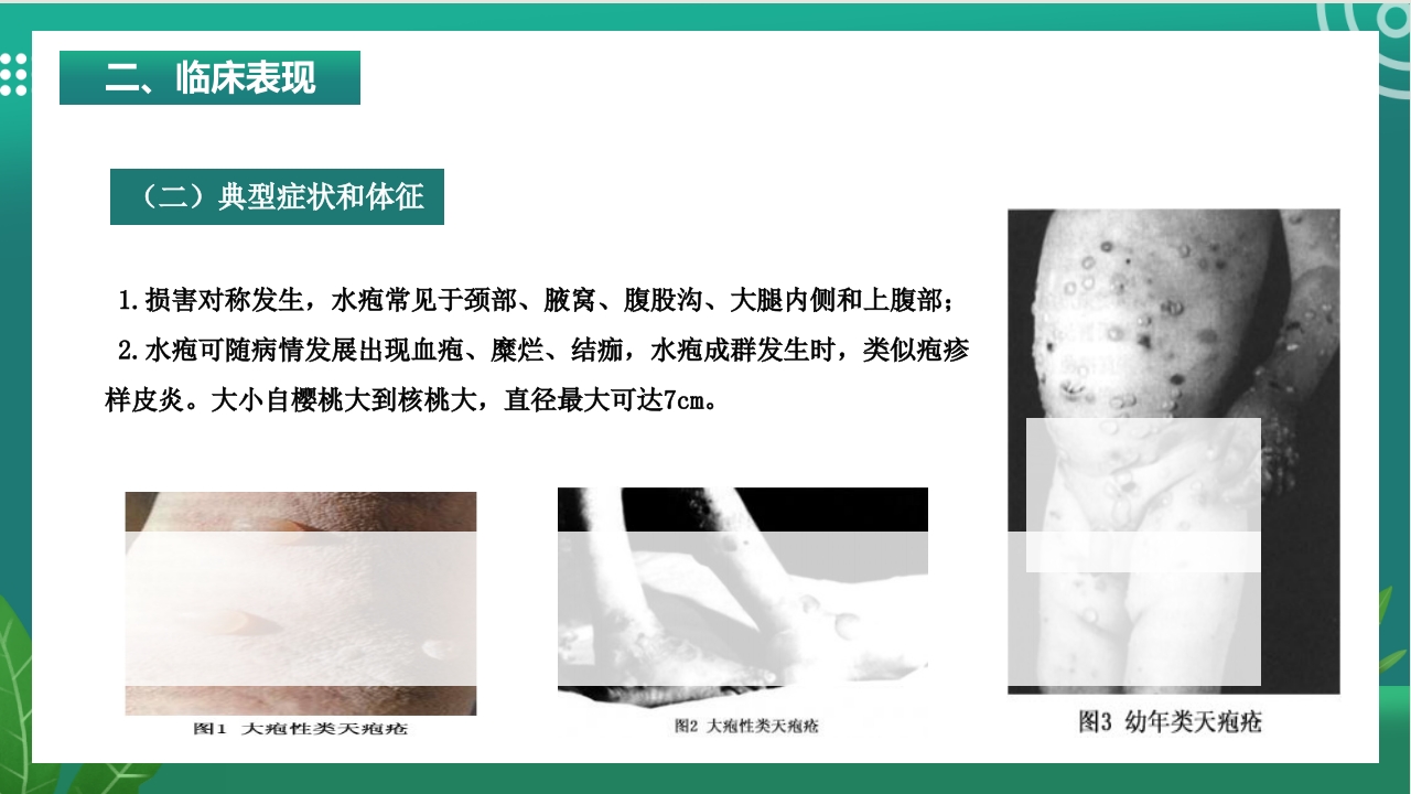 大疱性类天疱疮的护理ppt课件5
