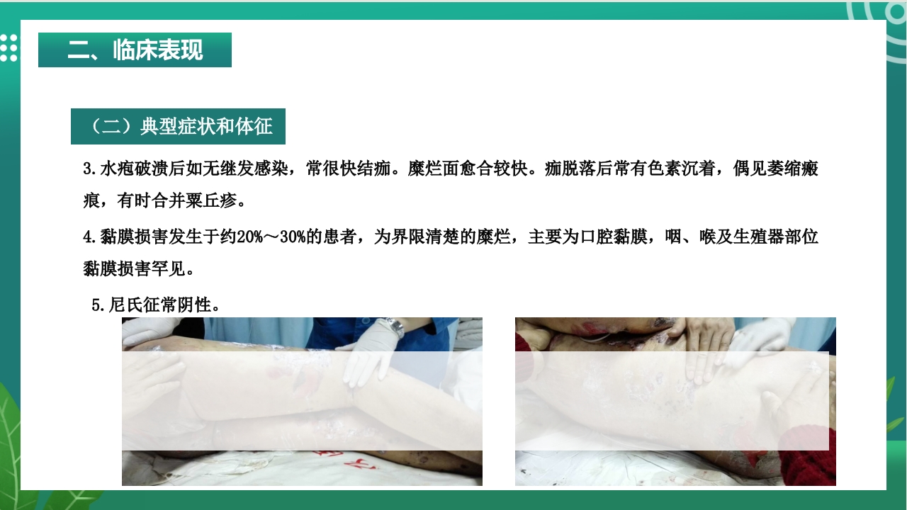 大疱性类天疱疮的护理ppt课件6