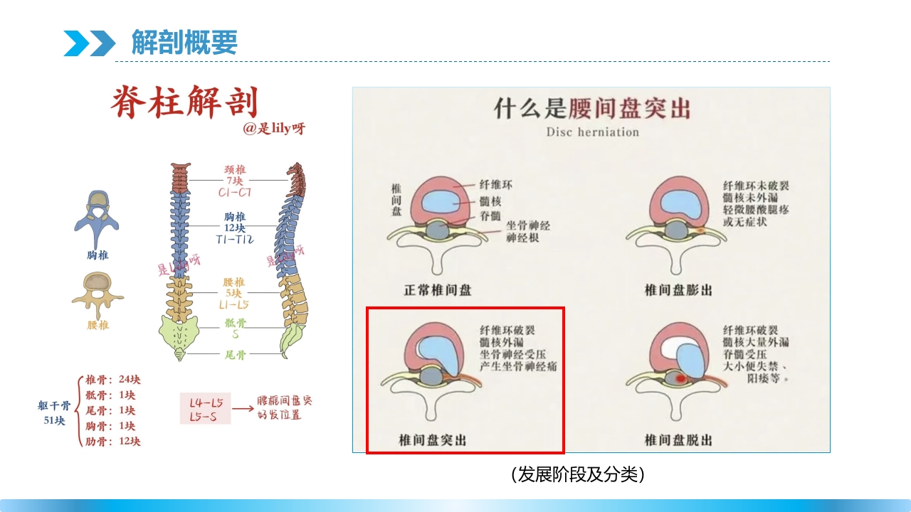 腰椎间盘突出理论培训PPT课件5
