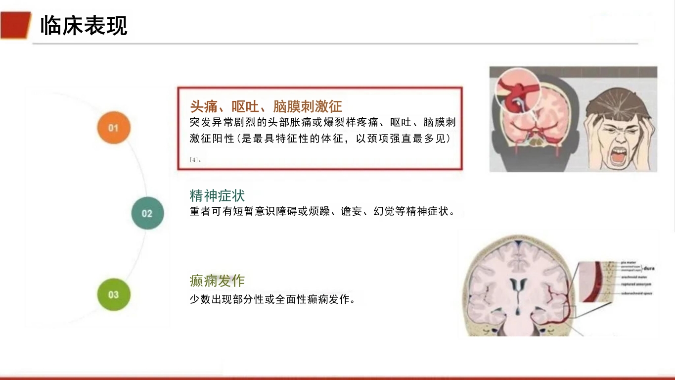 临床颅内动脉瘤破裂伴蛛网膜下腔出血的个案护理14