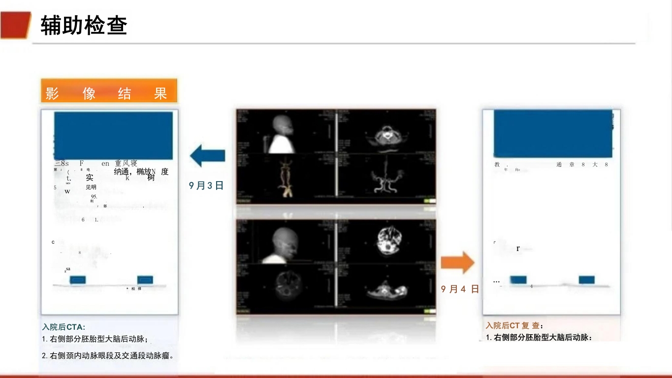 临床颅内动脉瘤破裂伴蛛网膜下腔出血的个案护理16