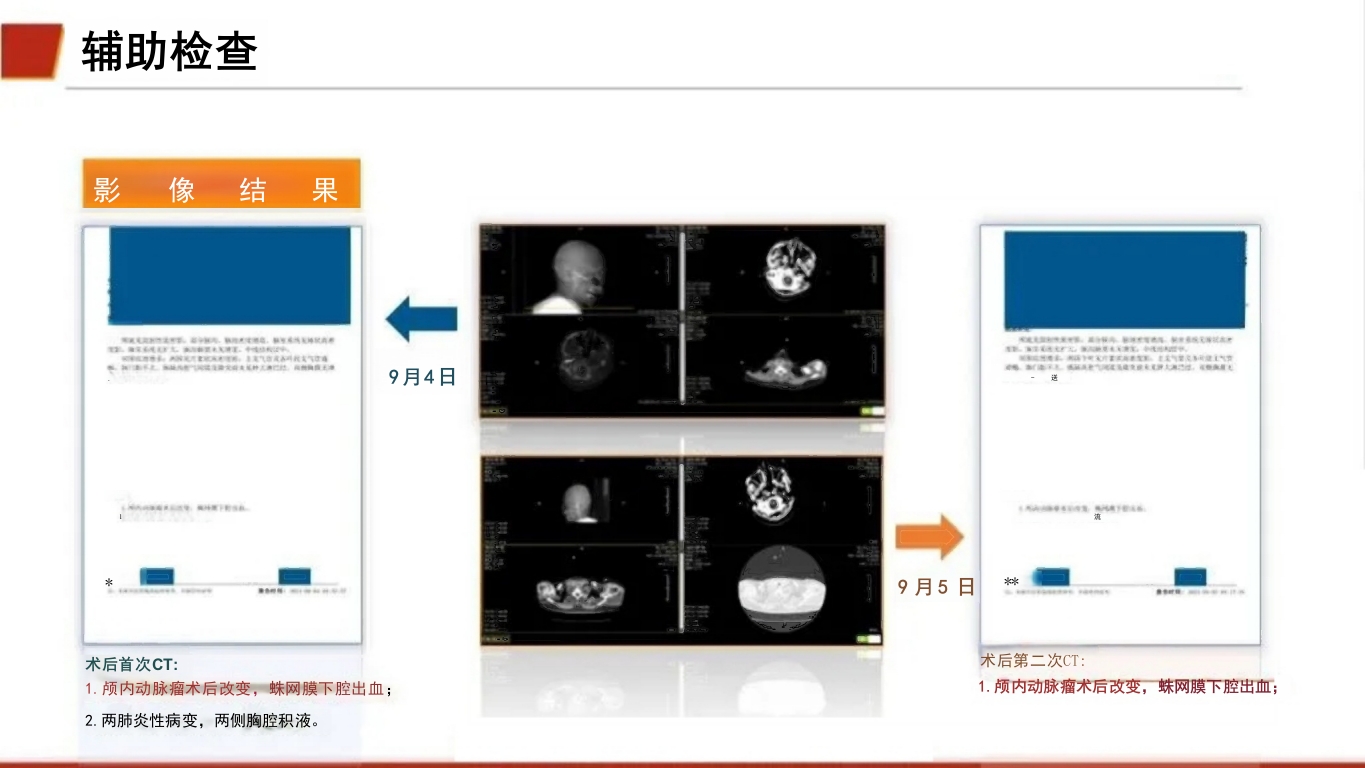 临床颅内动脉瘤破裂伴蛛网膜下腔出血的个案护理17