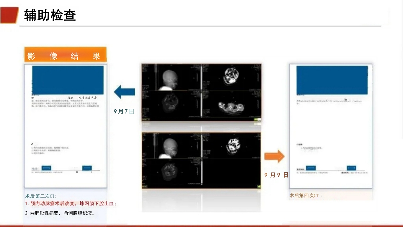 临床颅内动脉瘤破裂伴蛛网膜下腔出血的个案护理18
