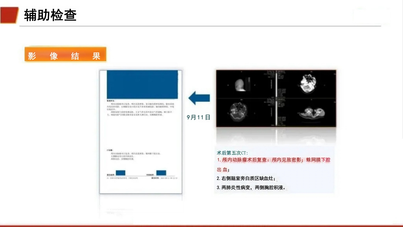 临床颅内动脉瘤破裂伴蛛网膜下腔出血的个案护理19