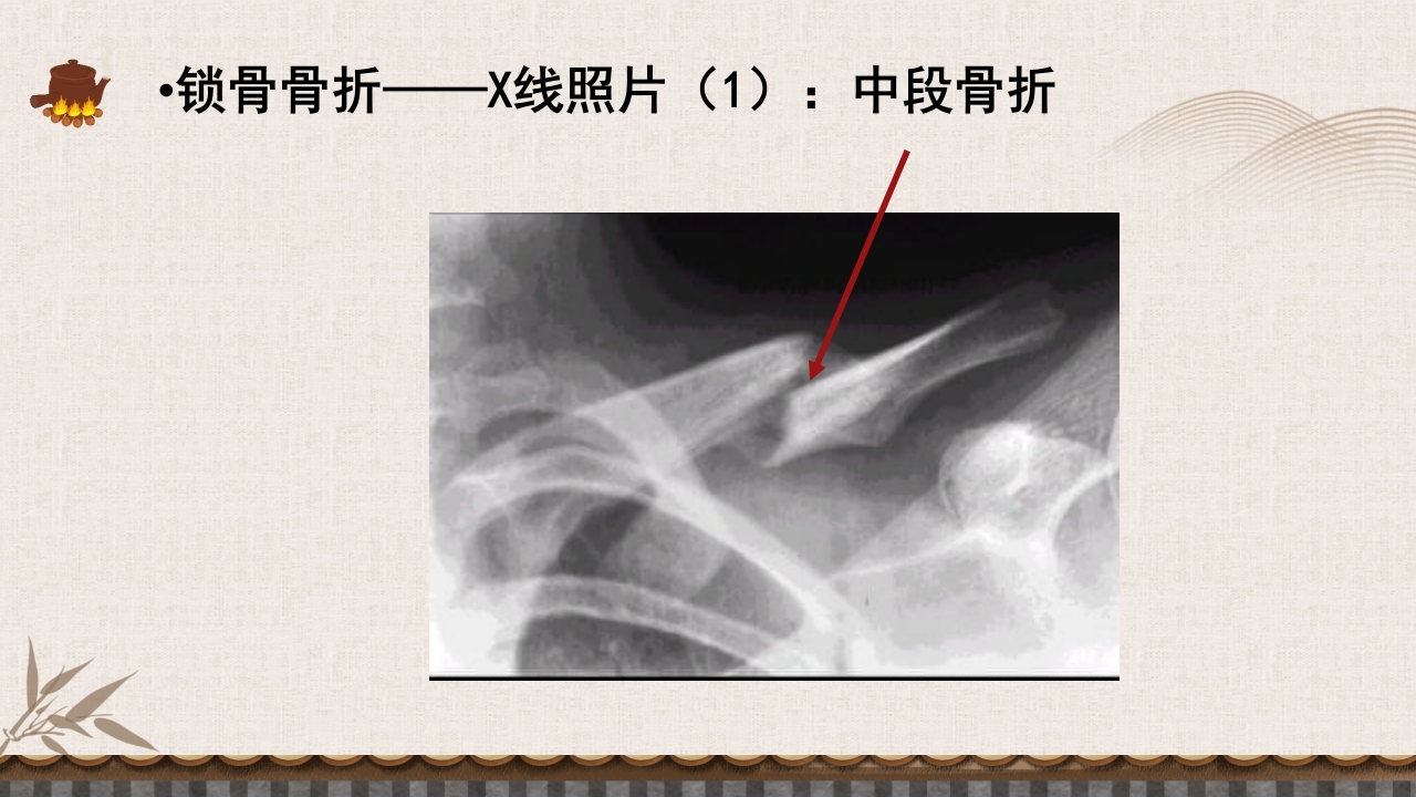 中医伤科上肢骨折护理查房PPT课件11
