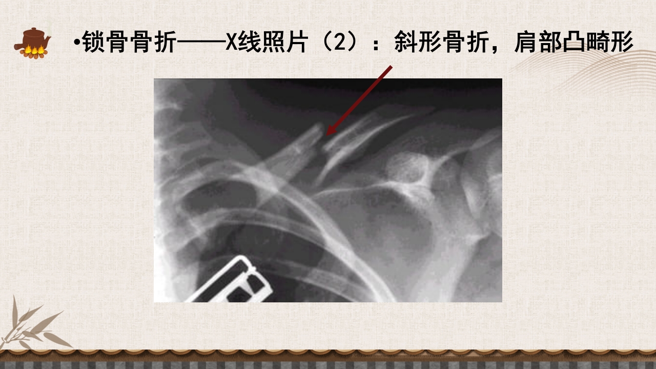 中医伤科上肢骨折护理查房PPT课件12