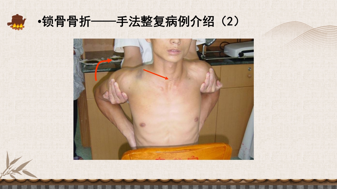 中医伤科上肢骨折护理查房PPT课件15