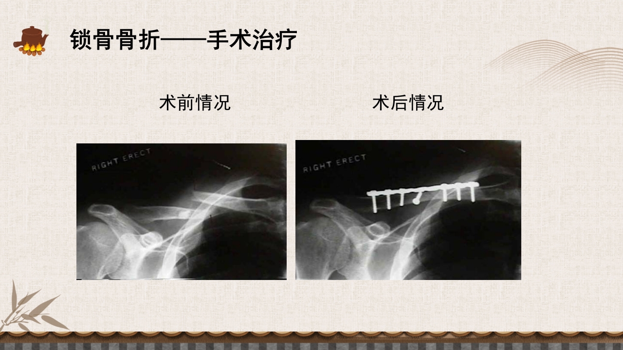 中医伤科上肢骨折护理查房PPT课件21