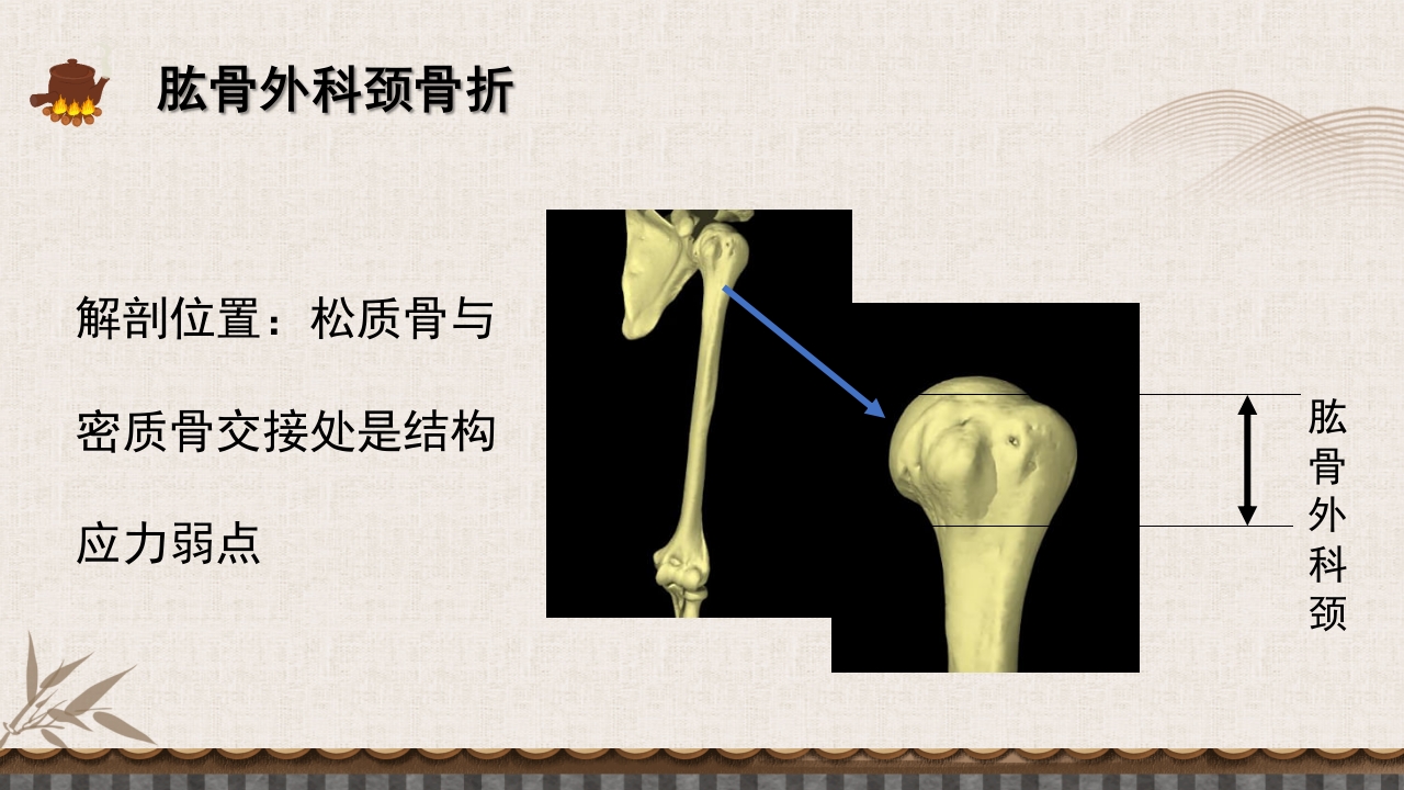 中医伤科上肢骨折护理查房PPT课件24