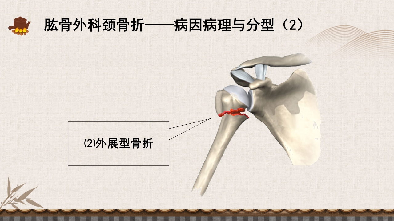 中医伤科上肢骨折护理查房PPT课件26