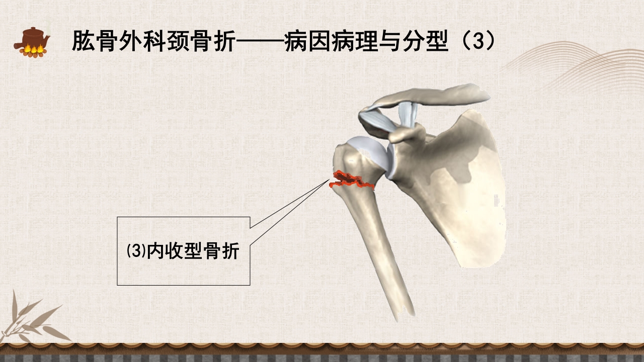 中医伤科上肢骨折护理查房PPT课件27