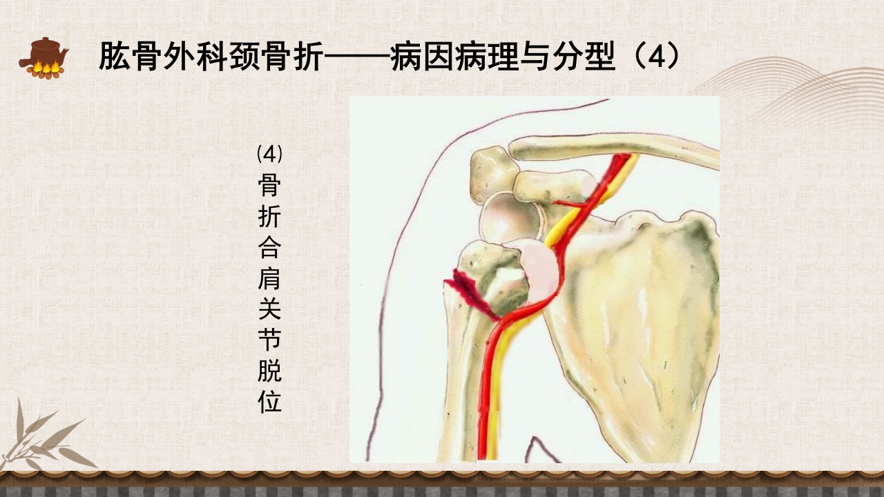 中医伤科上肢骨折护理查房PPT课件28