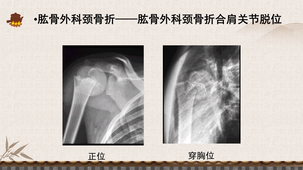中医伤科上肢骨折护理查房PPT课件30