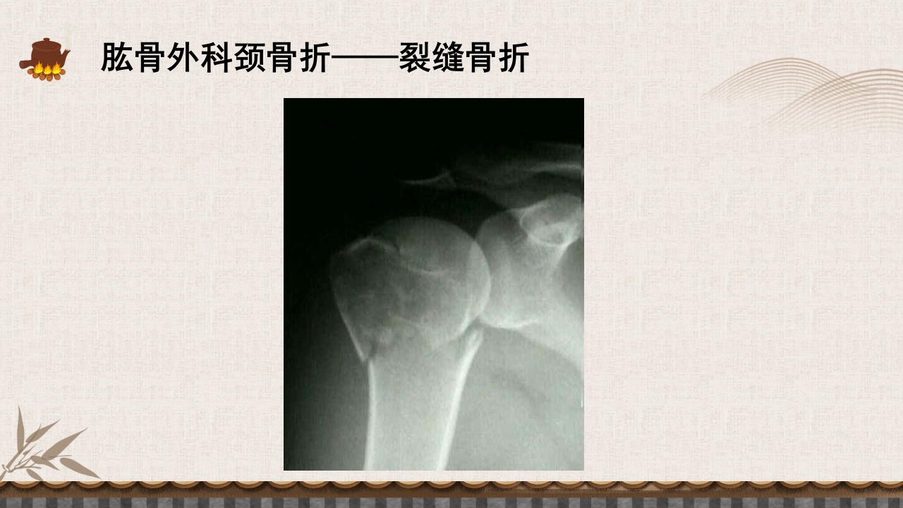 中医伤科上肢骨折护理查房PPT课件31