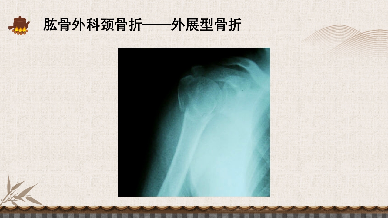 中医伤科上肢骨折护理查房PPT课件32