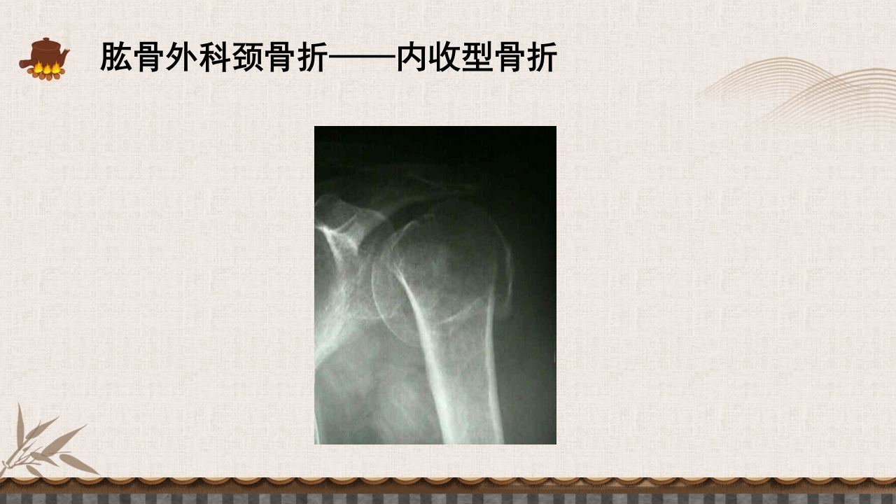 中医伤科上肢骨折护理查房PPT课件33