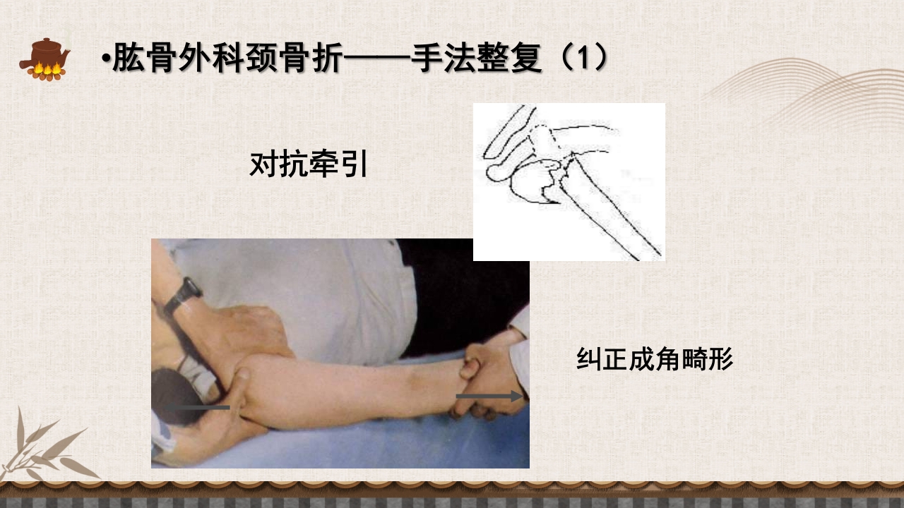 中医伤科上肢骨折护理查房PPT课件34