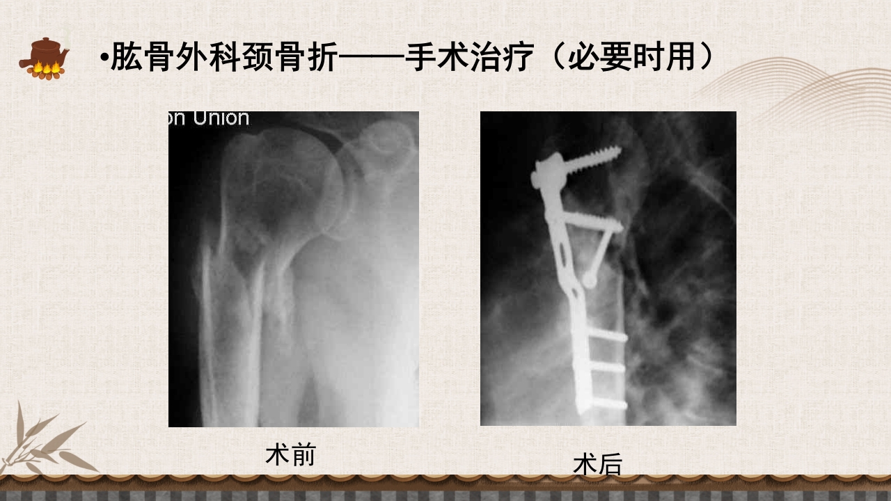 中医伤科上肢骨折护理查房PPT课件35