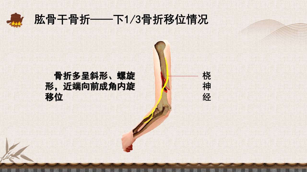 中医伤科上肢骨折护理查房PPT课件45