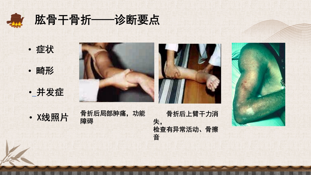 中医伤科上肢骨折护理查房PPT课件46