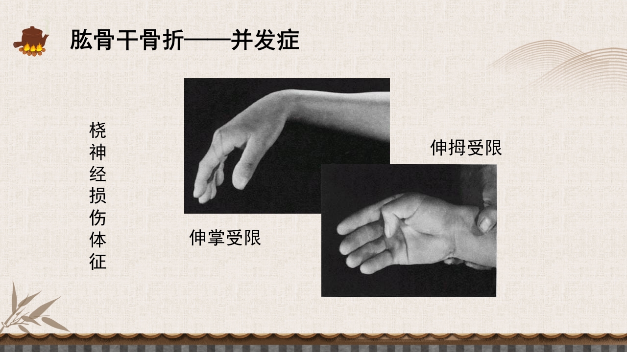 中医伤科上肢骨折护理查房PPT课件48